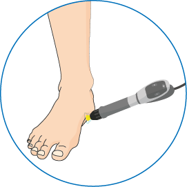 Illustration of shockwave therapy being applied to an ankle