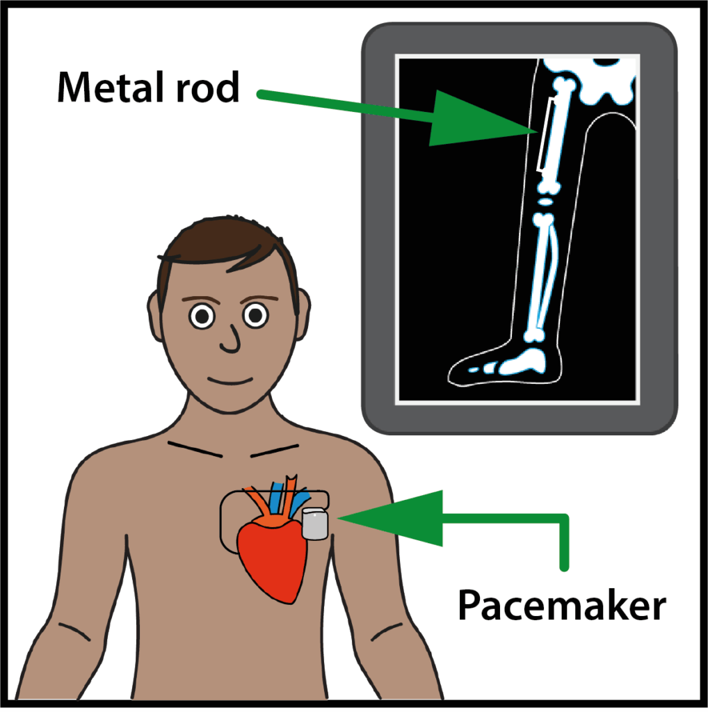 illustration of pacemaker on mans heart and x-ray showing metal rod used to repair broken leg