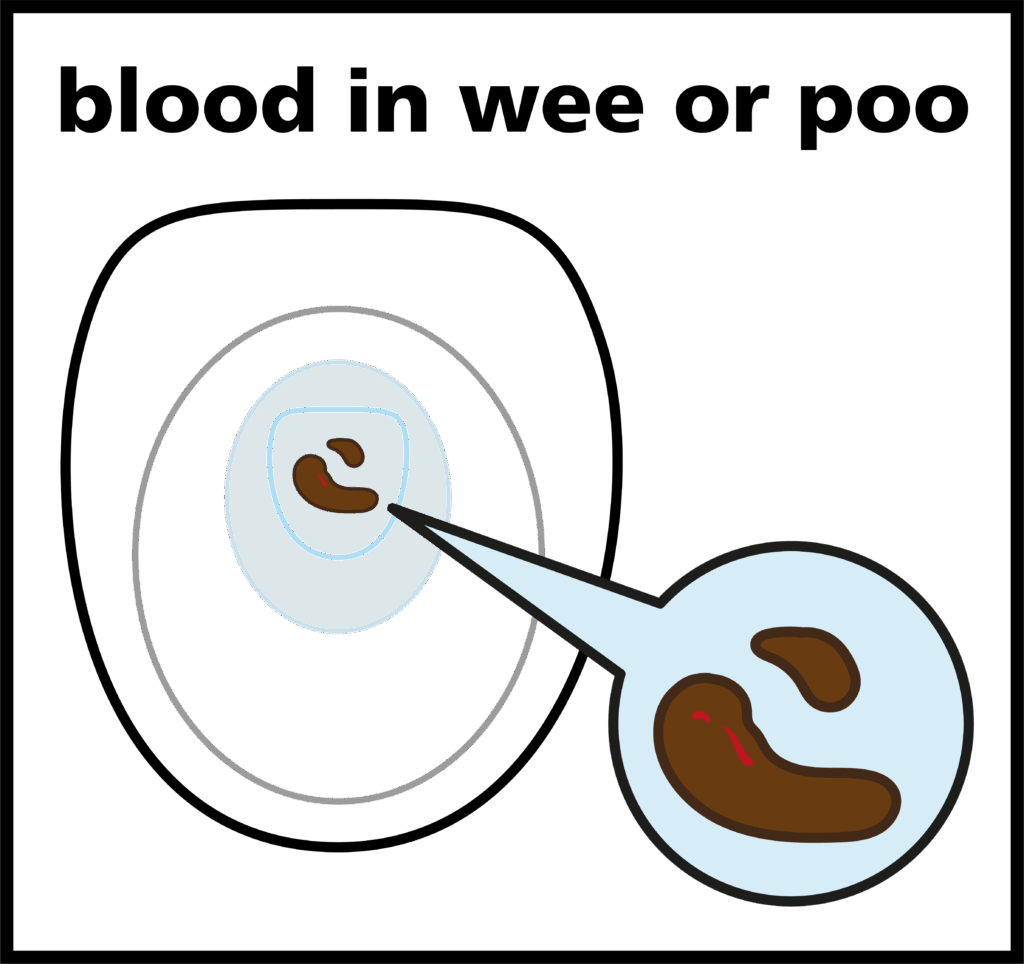 Illustration of poo with blood on in a toilet