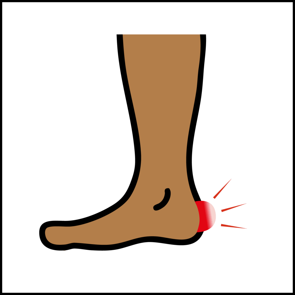 Image of a blister on the heel of a foot