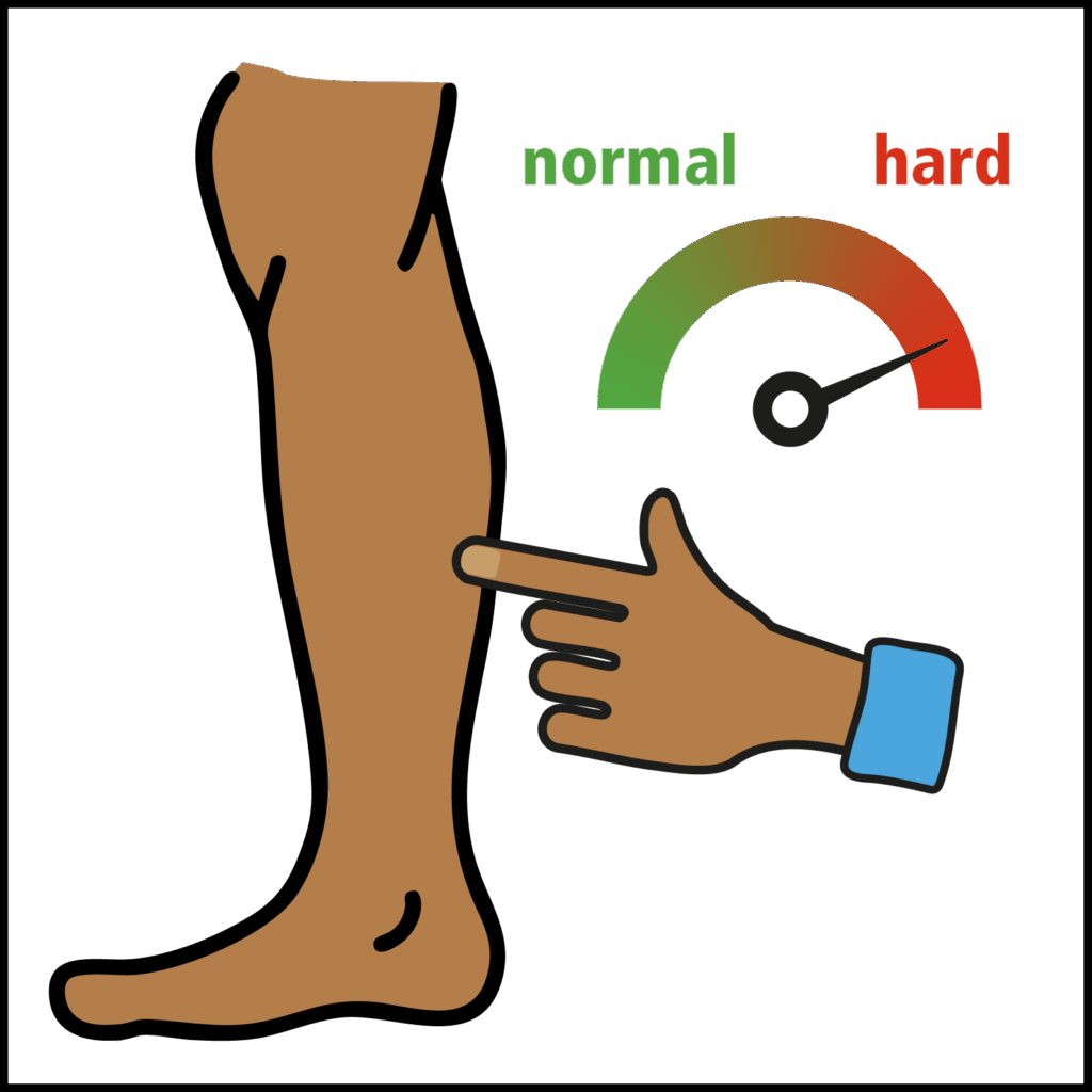 Illustration of a pointed finger touching a leg and a pointer indicating the skin is hard rather than normal