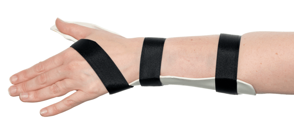 Photograph of hand and lower arm with a splint attached that covers the thumb and forearm.