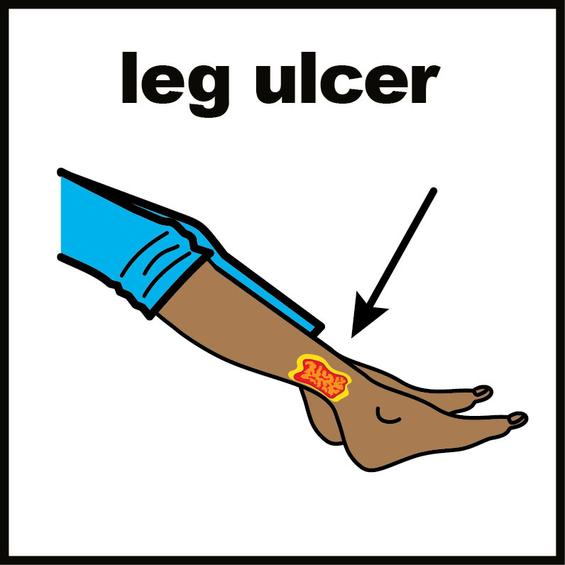 Illustration of a leg with an ulcer on above the heel