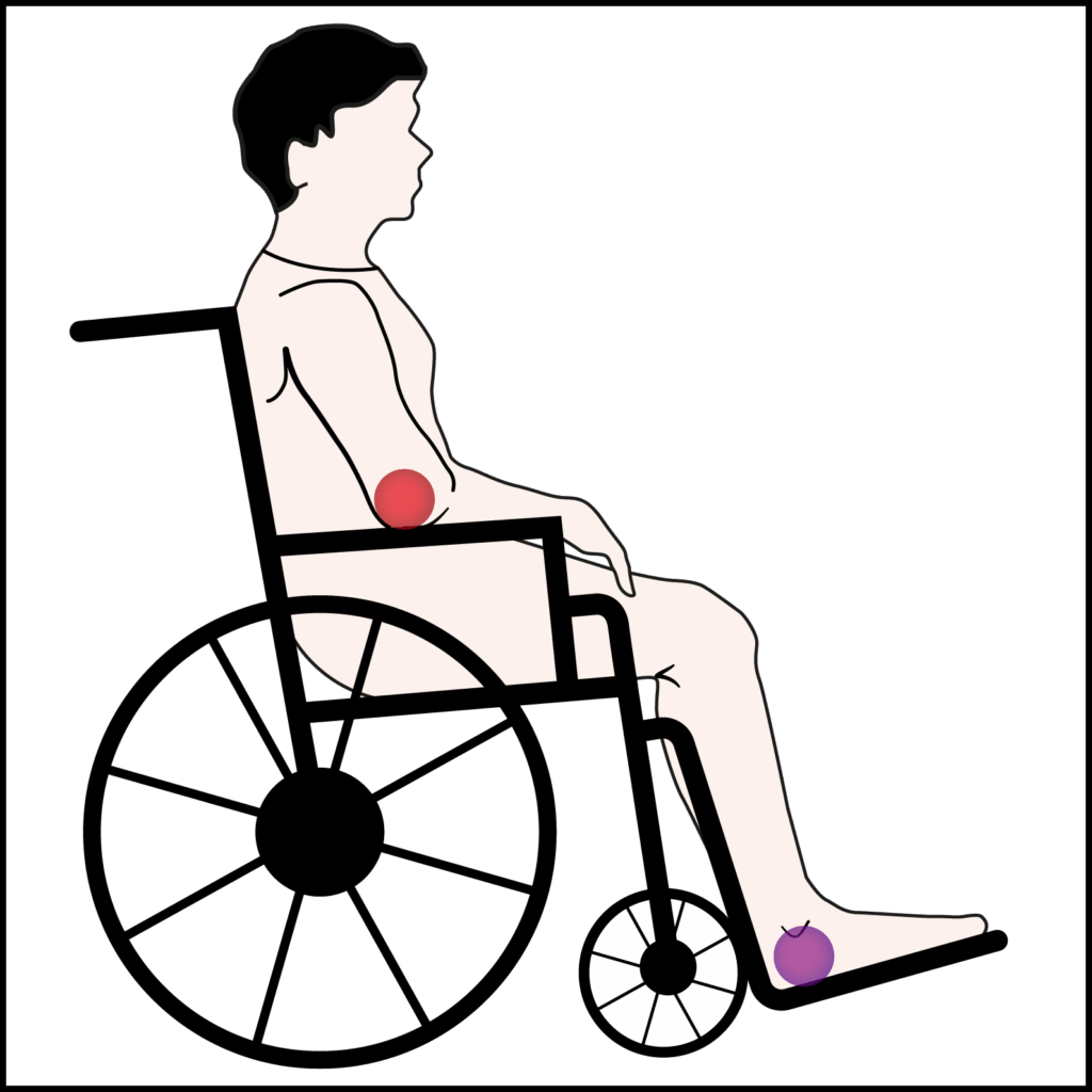 Illustration showing where patches of red or purple skin could be on a person in a wheelchair.