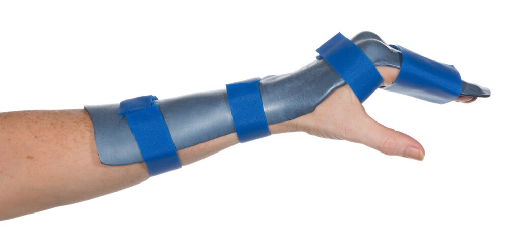 Image shows splint that covers hand and forearm
