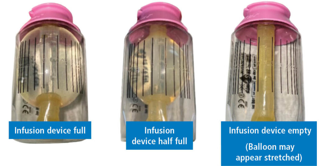 series of three images showing the shrinking of the device balloon over time.