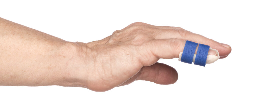 Photograph of Mallet Finger splint