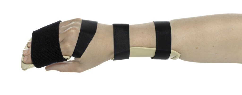 Picture of hand and lower arm held out from body in a splint
