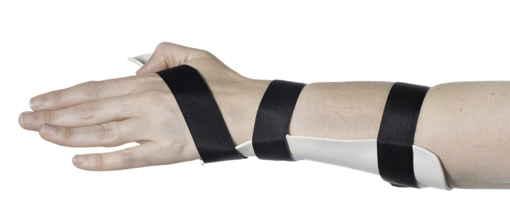 Photograph of hand and lower arm with a splint attached that covers the thumb and forearm.