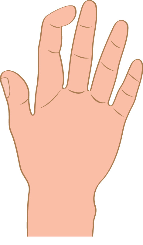 Illustration of Mallet Finger