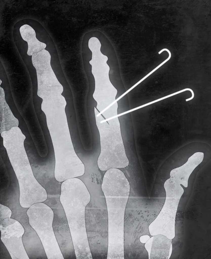 Image shows K wires inserted into bone to hold the fracture in position while it heals.