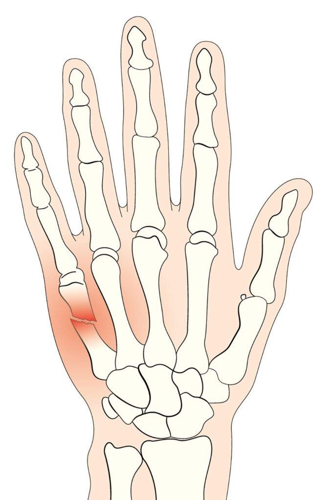 Illustration showing a Metacarpal fracture 