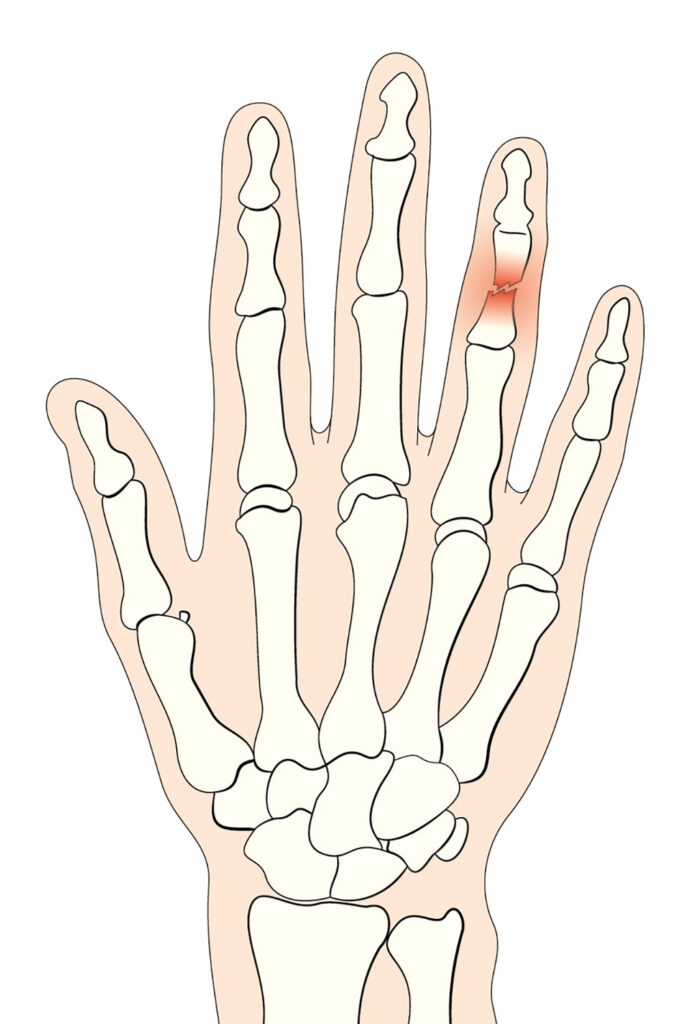 Illustration of Phalanx fracture