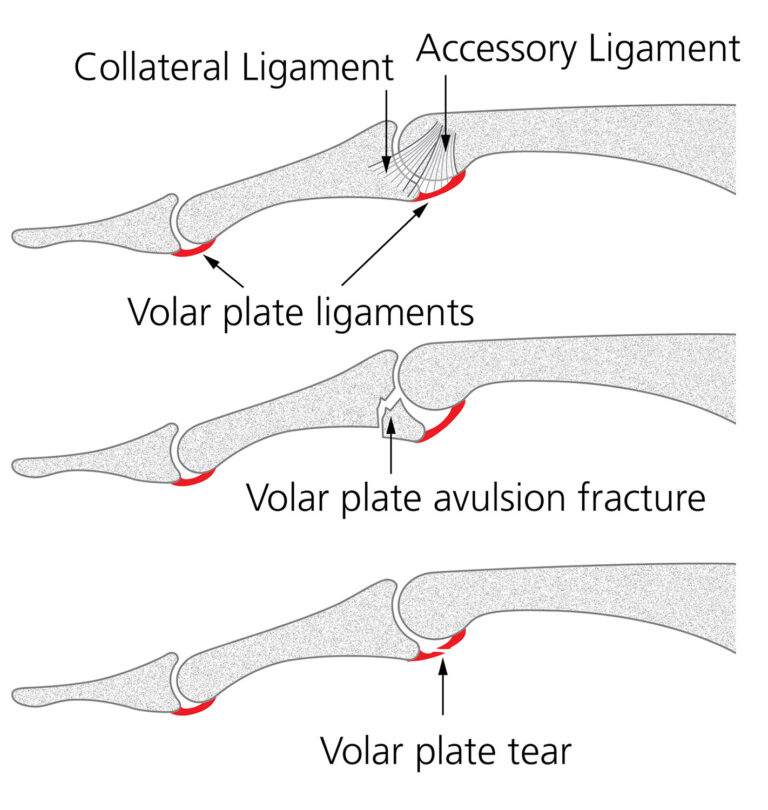image shows the 2 different types of Volar plate injuries, avulsion and tear.