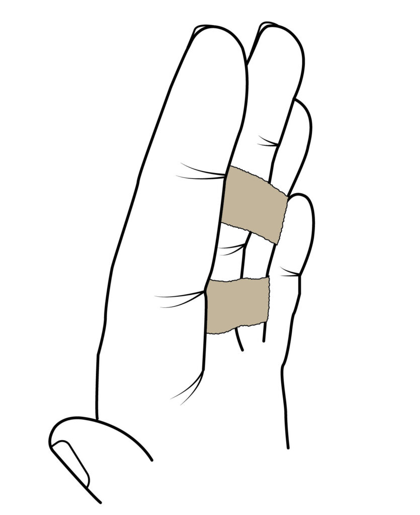 Image shows finger strapped to the finger next to it