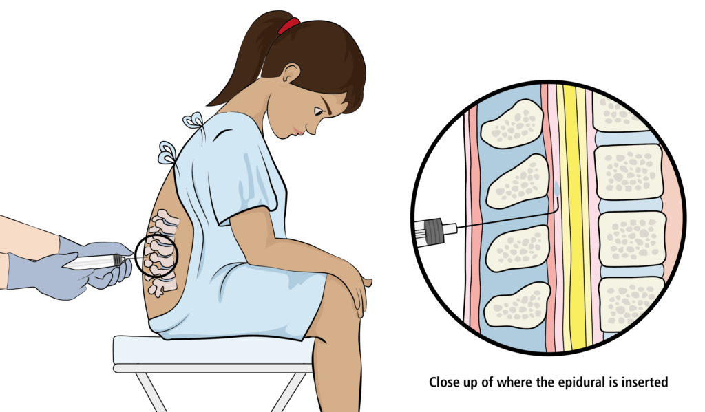 Illustration of a patient receiving an epidural and a close up of where the epidural is inserted.