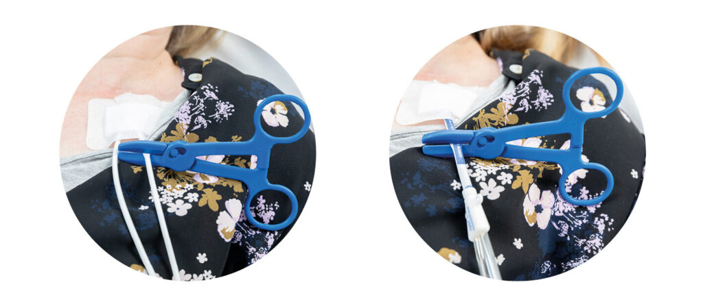 Two photographs, the first shows a blue clamp on a double dialysis line and the second shows a blue clamp on a single dialysis line.