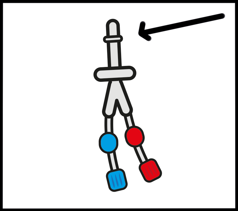 image of a dialysis line showing the lump that goes under the skin.