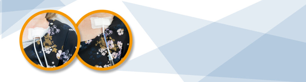 Header image showing 2 different types of renal dialysis line on a person. Blue texture in the background.