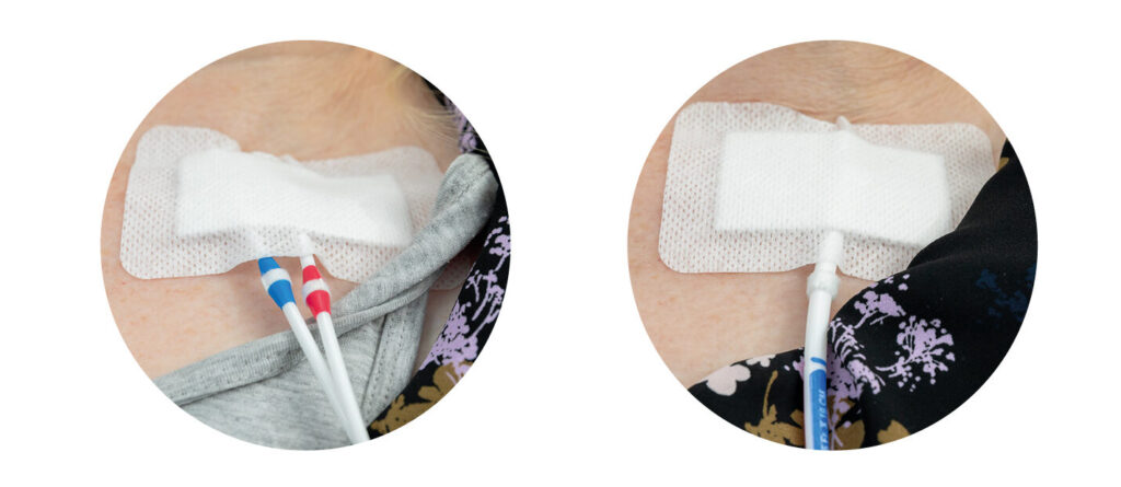 Photographs of two different types of renal dialysis lines, a double lumen line and a single lumen line, both have been pulled out of position.