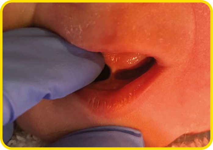A close up photograph of a baby with a tight tongue tie.