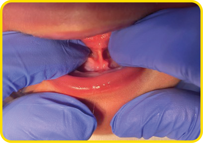 A close up photograph of a baby with a thick tongue tie.