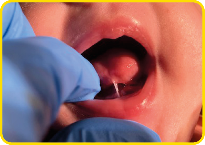 A close up photograph of a baby with a tongue tie.