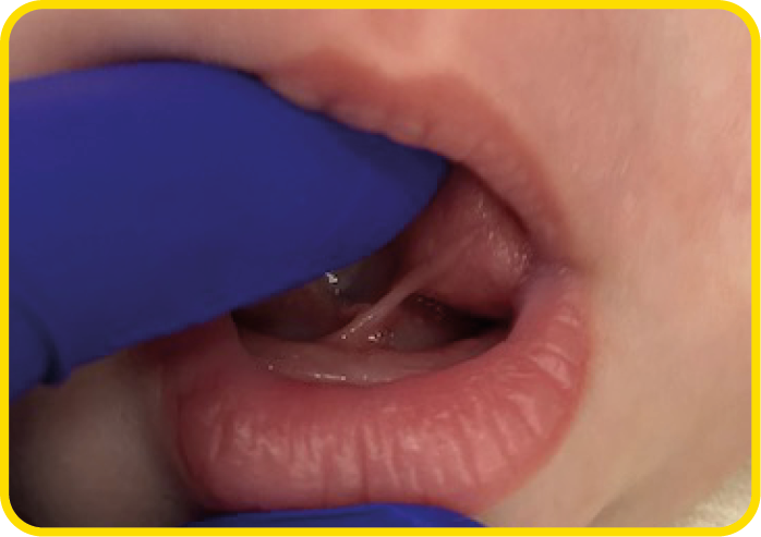 A close up photograph of a baby with a stretchy tongue tie.