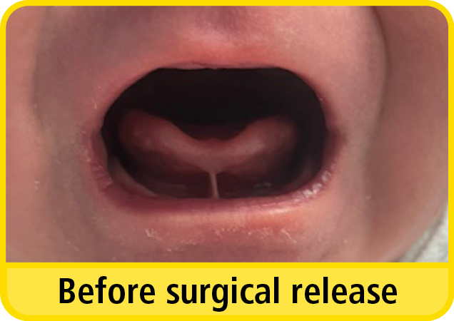 A close up photograph of a baby with a tongue tie before surgical release.