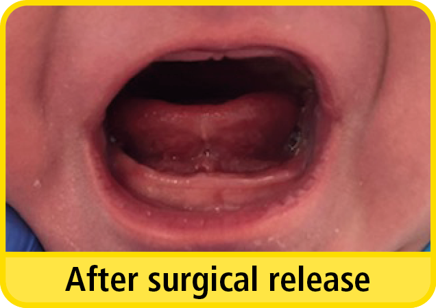 A close up photograph of a baby with a tongue tie after surgical release.