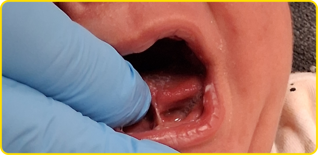 A close up photograph of a baby with a tongue tie.